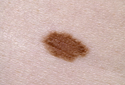 Entenda o câncer de pele não melanoma