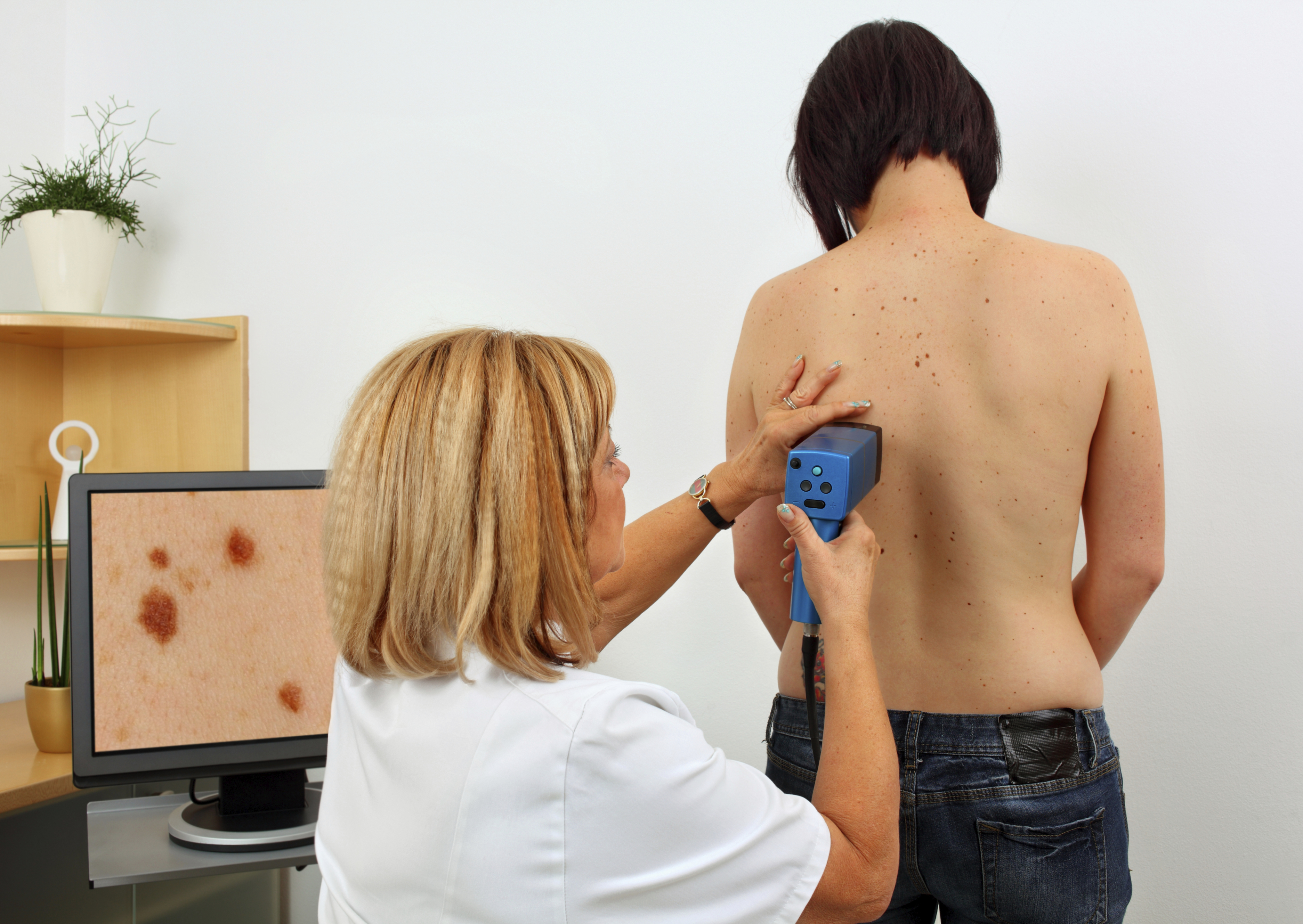 Na consulta com o dermatologista, não esqueça de pedir que ele examine seu corpo todo